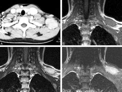 noduläre fasziitis|Nodular Fasciitis in the Head and Neck: CT and MR。